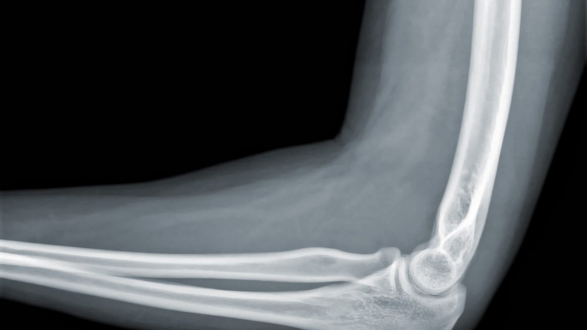 X-ray view of elbow