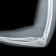 X-ray view of elbow