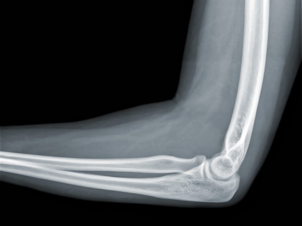 X-ray view of elbow